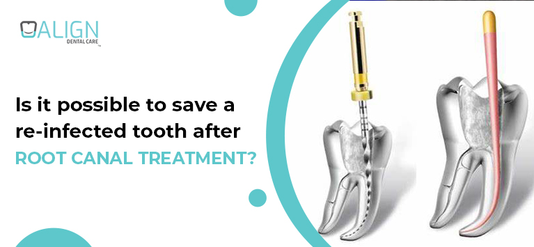 Is it possible to save a re-infected tooth after Root Canal Treatment?