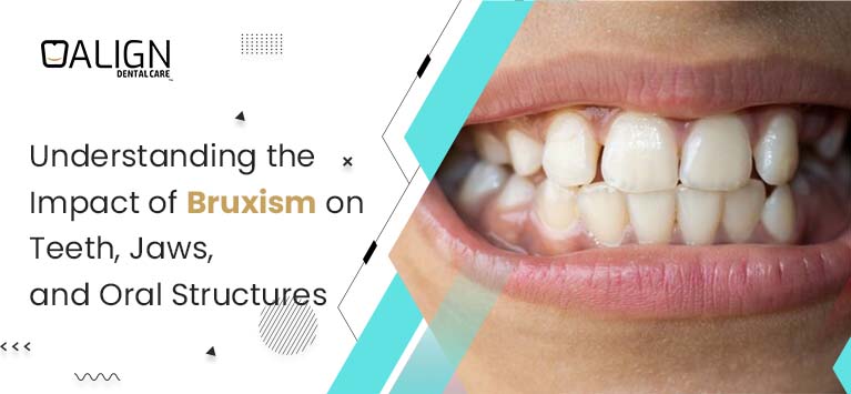 Understanding the Impact of Bruxism on Teeth, Jaws, and Oral Structures