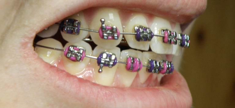 Metallic Brace