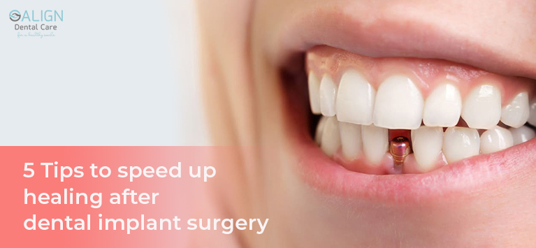 5 Tips to speed up healing after dental implant surgery