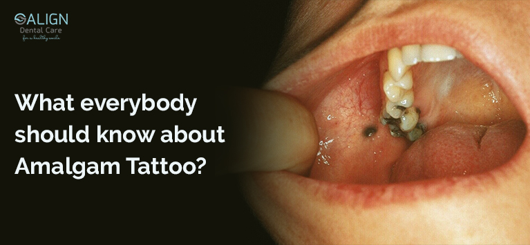 Amalgam tattoo characterized by the dark-blue macule on the buccal... |  Download Scientific Diagram