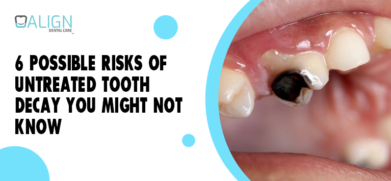 6 possible risks of untreated tooth decay you might not know