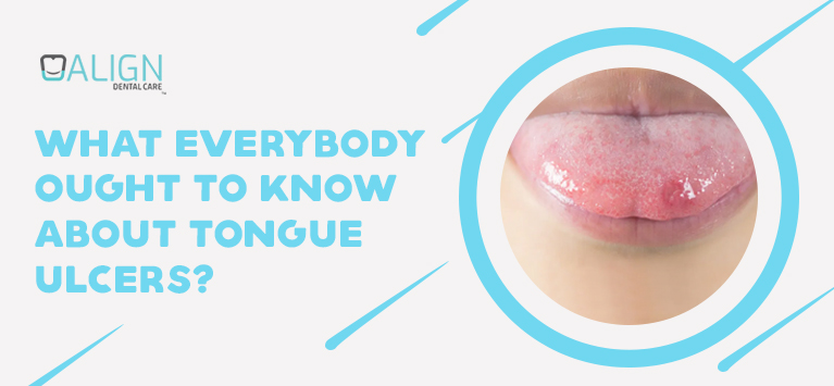 What everybody ought to know about tongue ulcers