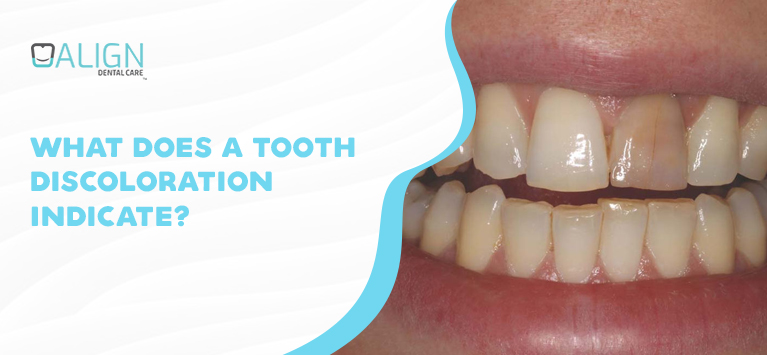 What does a tooth discoloration indicate?