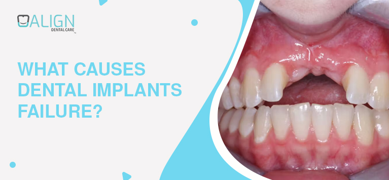 What Causes Dental Implants failure?