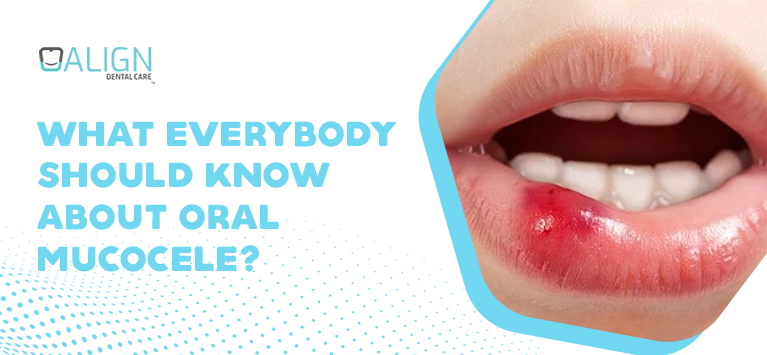 What everybody should know about oral mucocele?