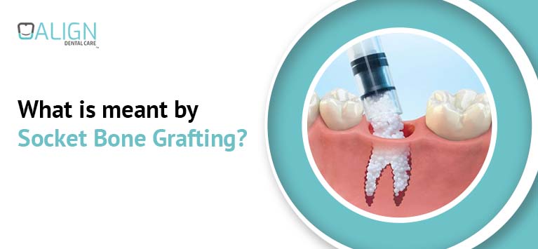 What is meant by Socket Bone Grafting?
