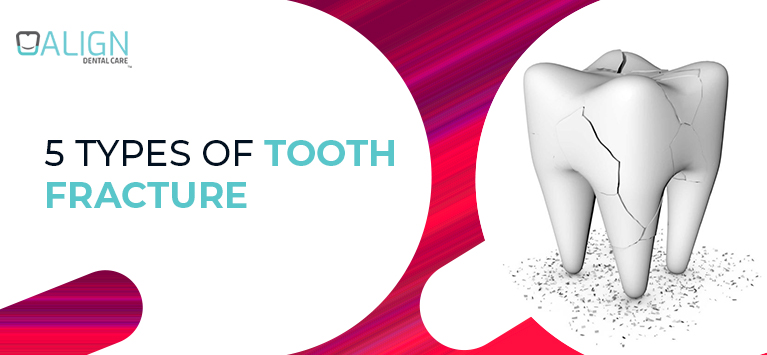 5 types of tooth fracture