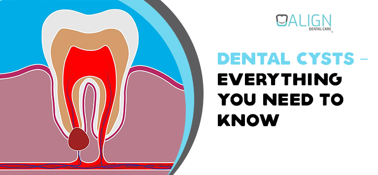 Dental cysts – Everything you need to know