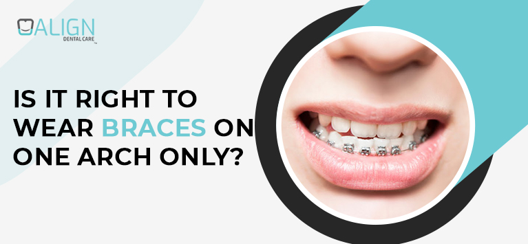 Is it right to wear braces on one arch only?