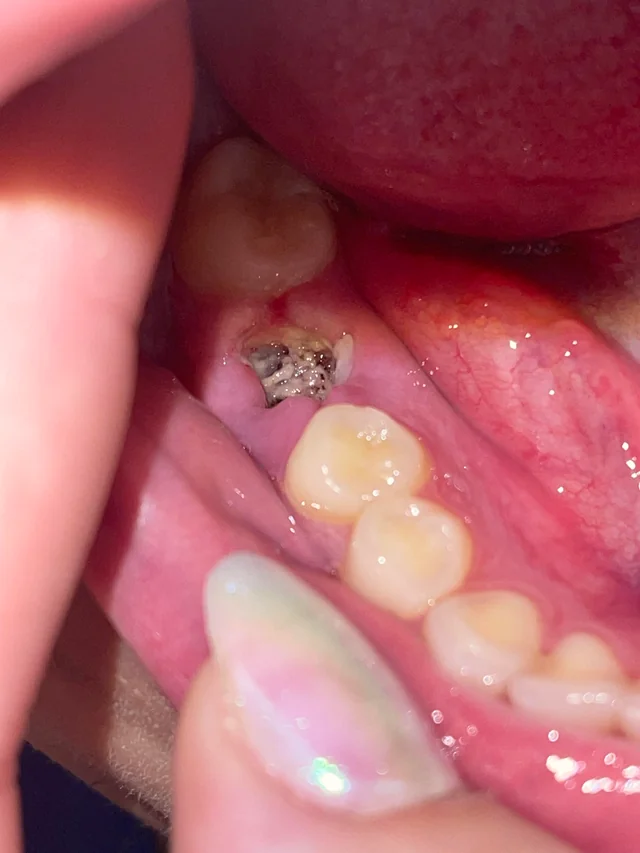 dental dry socket images