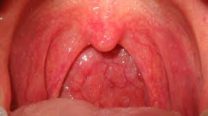 Red Spots on Roof of Mouth Pictures