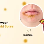 Impetigo vs Cold Sores