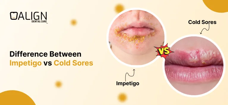 Impetigo vs Cold Sores