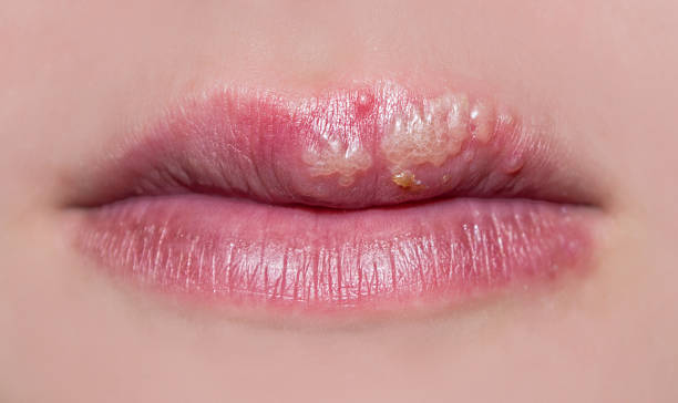 cold sore or herpes images