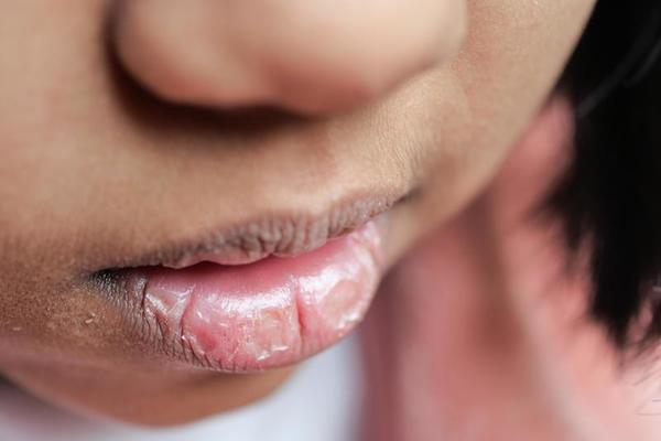 itchy roof of mouth due to dry mouth 