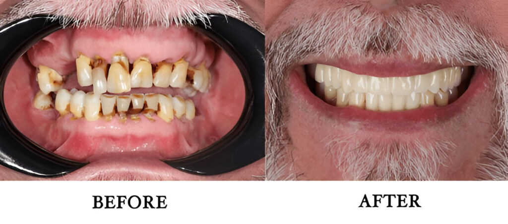 Rotten teeth images in adults before and after