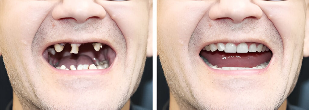 Rotten teeth images in adults before and after