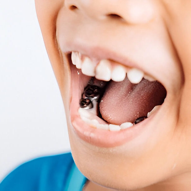 Pictures of Rotten Teeth in Kids