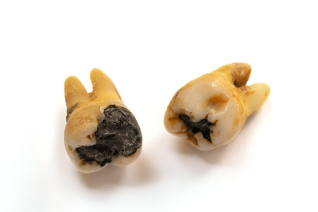 rotten tooth images