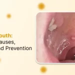 HPV in the Mouth