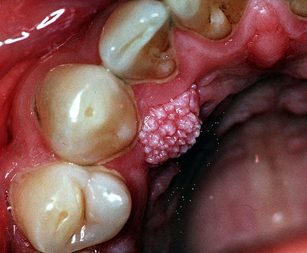 HPV Images in the Mouth