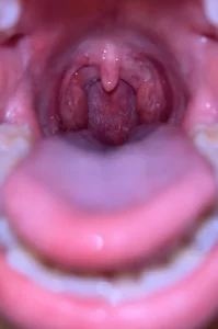 HPV Images in the Mouth