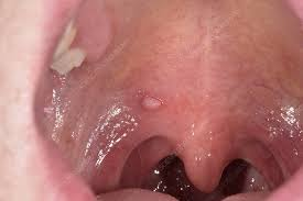 HPV Images in the Mouth